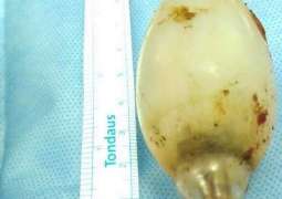 11 year old Light bulb 'recovered' from stomach of a 21 year old boy