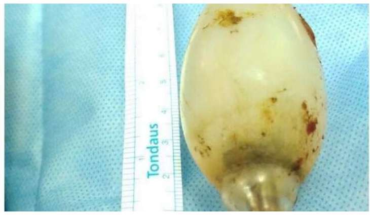 11 year old Light bulb 'recovered' from stomach of a 21 year old boy