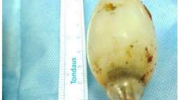 11 year old Light bulb 'recovered' from stomach of a 21 year old boy