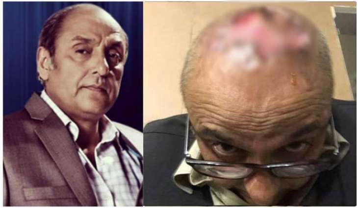 Pakistani Actor Sajid Hasan's hair transplant surgery gone horribly wrong