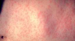 Ukraine Records More Than 70% of Europe Measles Cases in 2019 - World Health Organization