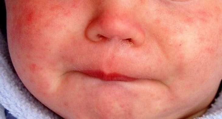 Number of US Measles Cases Reaches 1,022 in Worst Outbreak Since 1992 - CDC