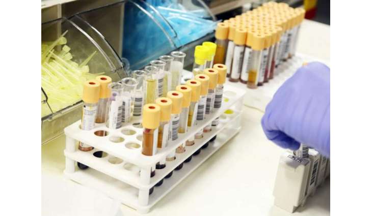 Urine test can help diagnose aggressive prostate cancer