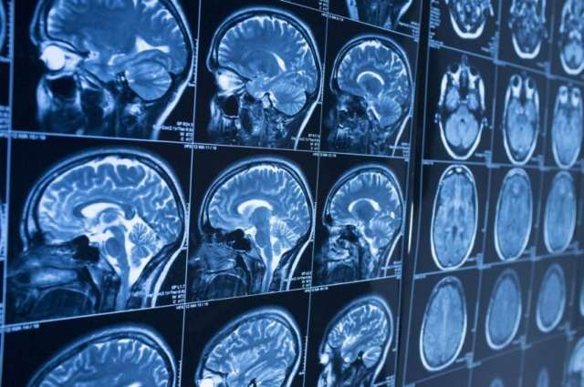 New approach may save brain cells in neurodegenerative diseases