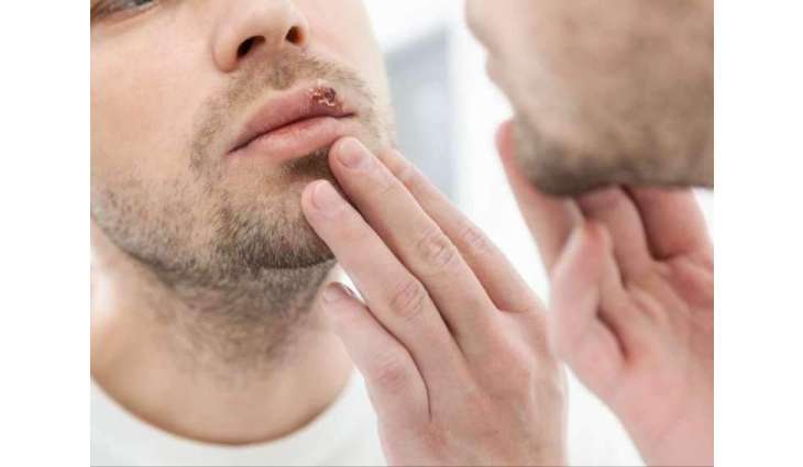 How dormant herpes springs back to life