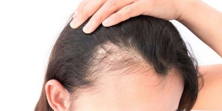 How to treat female hair loss