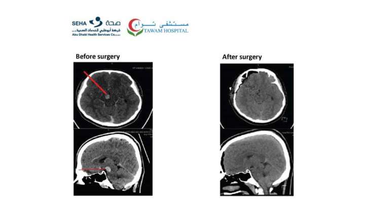 Tawam Hospital achieves milestone in complex brainstem surgery