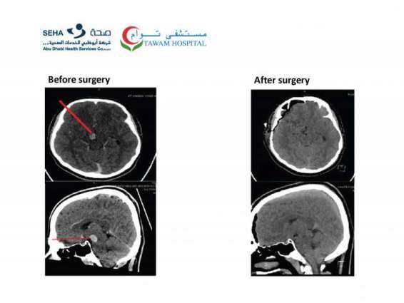 Tawam Hospital achieves milestone in complex brainstem surgery