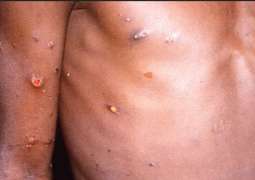 EU Closely Monitoring Monkeypox Outbreak Within Bloc as Cases Grow - Commission