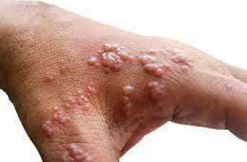 Monkeypox Infiltrated Madrid in Late April - Health Official