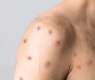 Malta Confirms First Case of Monkeypox - Reports