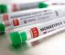 Madrid Starts Monkeypox Testing in 5 Hospitals - Reports