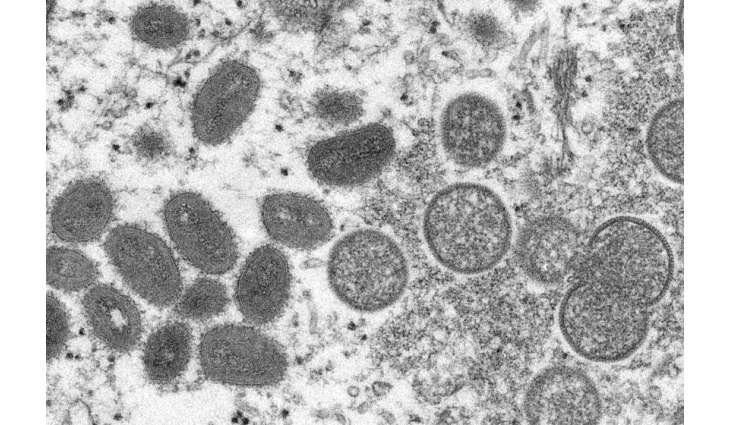 California Public Health Officials Report First Suspected Case of Monkeypox