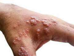 Monkeypox Infiltrated Madrid in Late April - Health Official