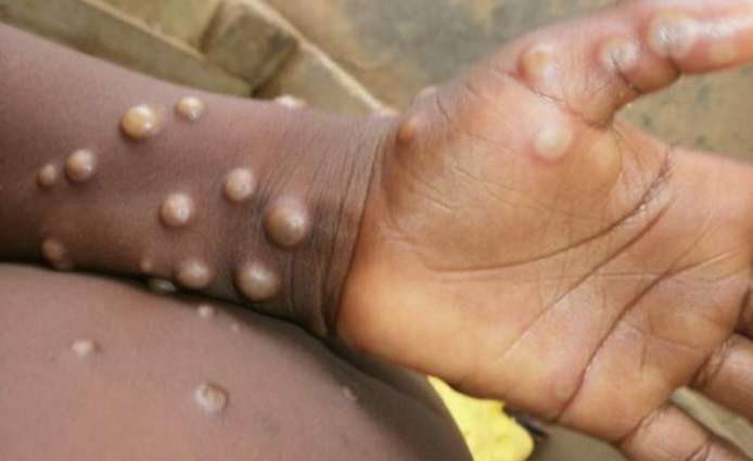 UK Health Authorities Report Monkeypox Case in England