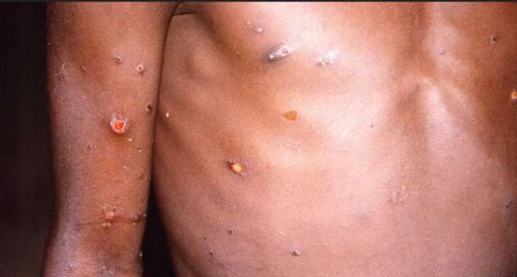 EU Closely Monitoring Monkeypox Outbreak Within Bloc as Cases Grow - Commission