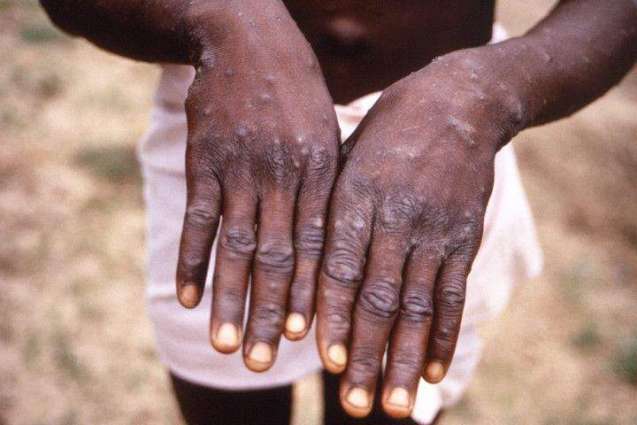 WHO Says Aware of 37 Confirmed Monkeypox Cases