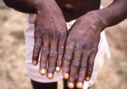 Romania Reports Two New Monkeypox Cases in Past 24 Hours - Health Ministry