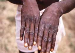 Iran Registers First Monkeypox Case - Health Ministry