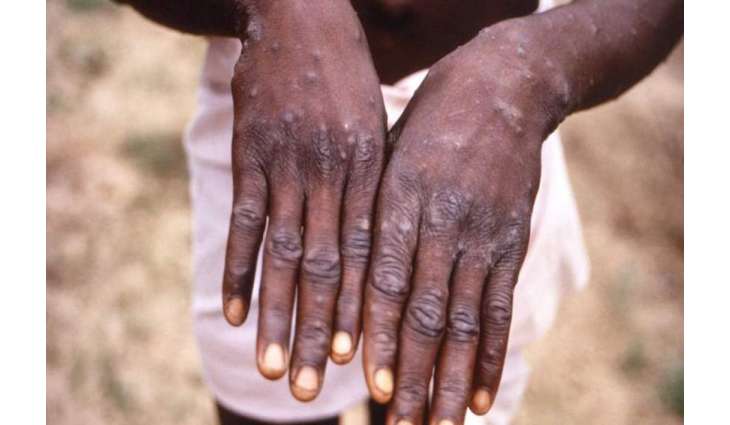 Iran Registers First Monkeypox Case - Health Ministry