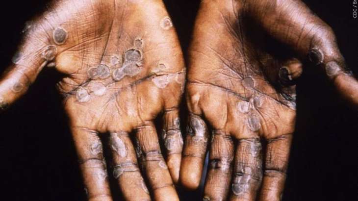 US Reports Over 25,300 Monkeypox Cases Across All 50 States - Centers for Disease Control