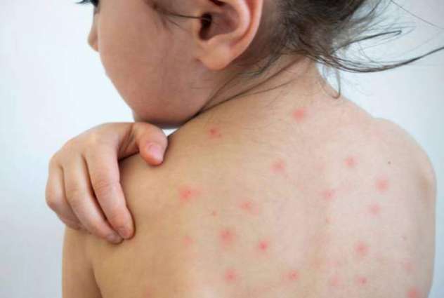 Over 140 Measles Cases Detected in Armenia - Health Ministry