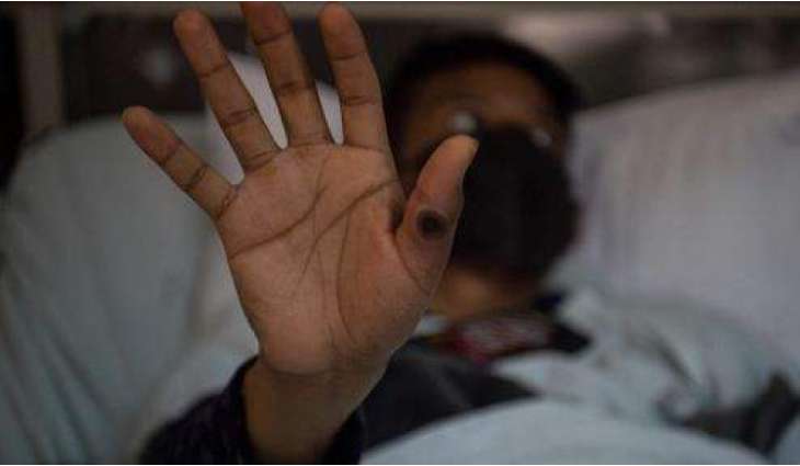 Pakistan reports second Mpox case in Peshawar