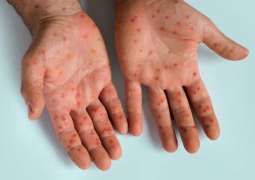Measles outbreaks end in Michigan, Pennsylvania