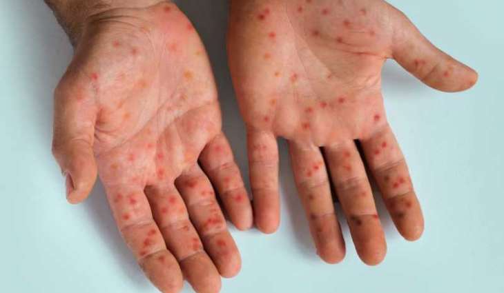 Measles outbreaks end in Michigan, Pennsylvania