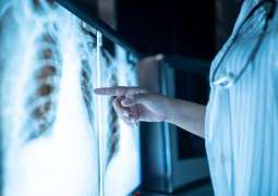 Scientists identify main driver of early-stage lung cancer development
