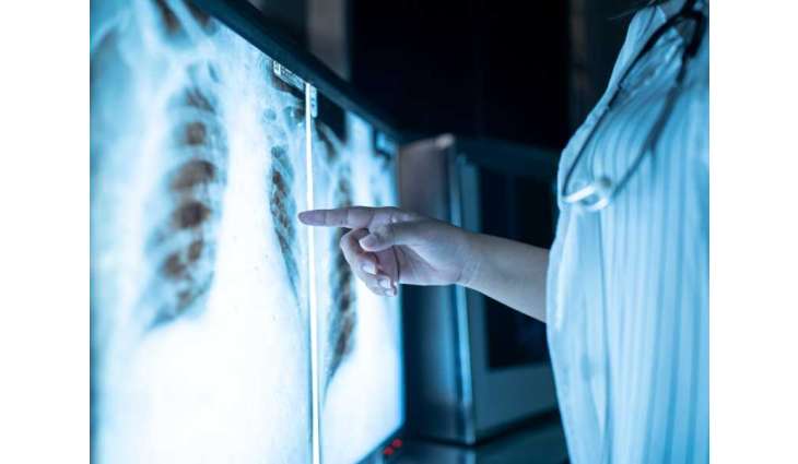 Scientists identify main driver of early-stage lung cancer development
