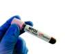 Madagascar mpox cases top 3,000 since outbreak in December 2025